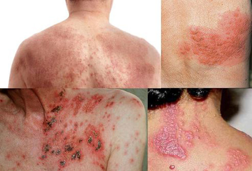 Are You Over 50? Then, You Need to Get a Shingles Shingrix Shot SOON !!!